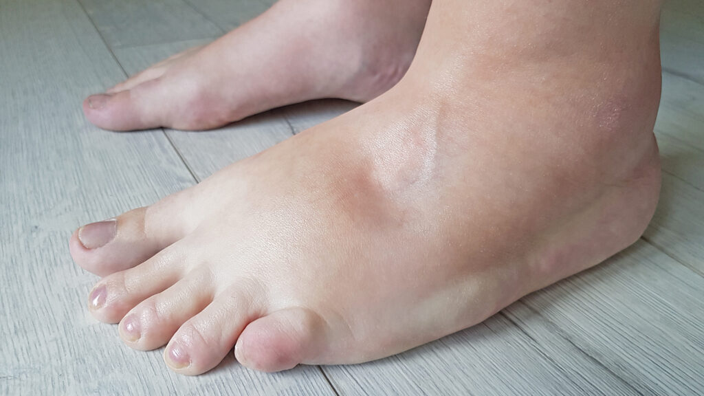 Edema is caused by the accumulation of fluid in the body.
