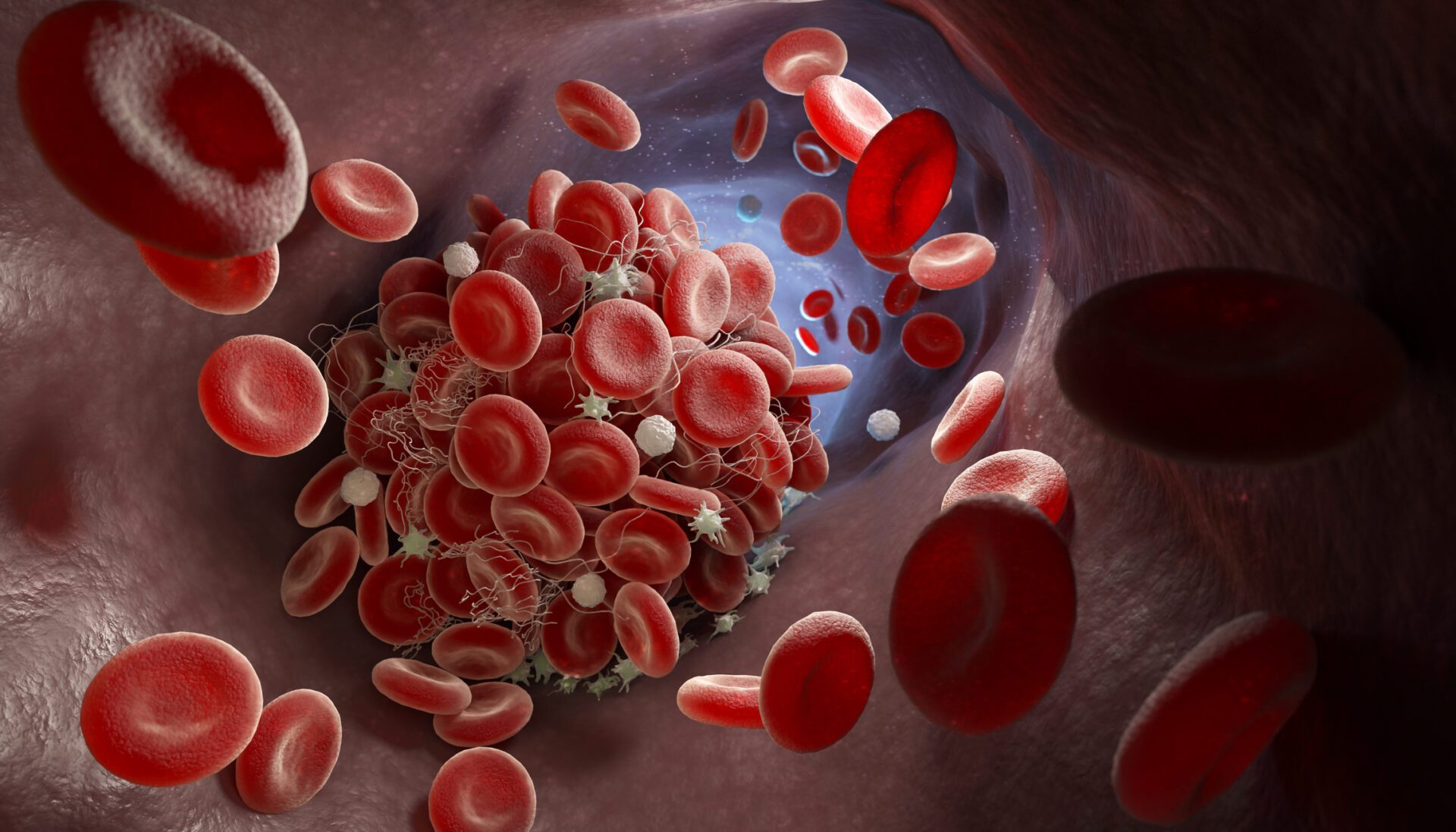 Blood clots in the blood vessels form blocks that prevent the free flow of blood. This can cause very serious health problems.