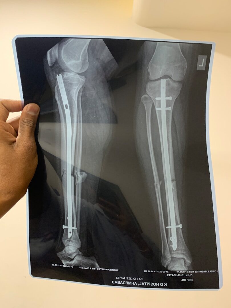 In older people, bone fractures are a very complicated problem. Unfortunately, they occur frequently, especially in women.
