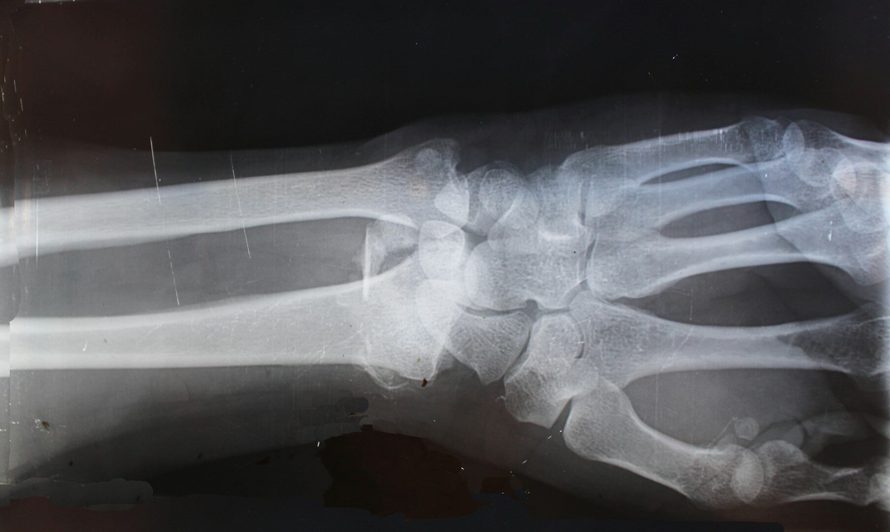 The swelling will appear. X-rays will show a fracture. But you don't feel any pain.